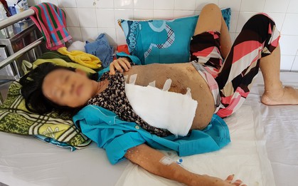 Lấy khối u khổng lồ nặng 6,3kg ra khỏi ngực một người phụ nữ ở Đà Nẵng