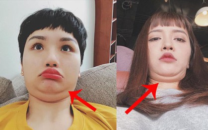 "Hai cằm" là cơn ác mộng của nhiều người nhưng nguyên nhân do đâu thì đố bạn biết đấy!