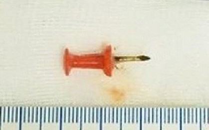 Nuốt phải đinh sắt 1,5cm vào bụng, bé 2 tuổi suýt chết