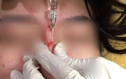 Clip tiêm Filler vào mũi sau đó bóp nặn thành dáng cao dài thẳng tắp đang được nhiều chị em chia sẻ vì... quá đáng sợ