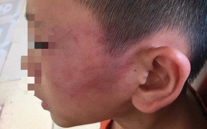 Nghệ An: Nghi án bé trai 12 tuổi bị mẹ kế đánh thương tích đầy mình phải nhập viện
