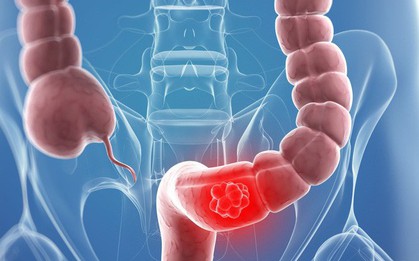 5 nguyên nhân không ngờ gây ung thư đại tràng mà nhiều người vẫn chủ quan bỏ qua