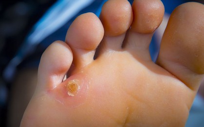 6 vấn đề sức khỏe biểu hiện ở bàn chân mà bạn tuyệt đối không nên bỏ qua