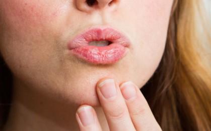 Ngoài liếm môi thì đây cũng là những nguyên nhân phổ biến gây ra tình trạng môi khô nứt nẻ
