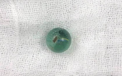Cứu sống bé gái 6 tuổi nuốt viên bi vào khí quản