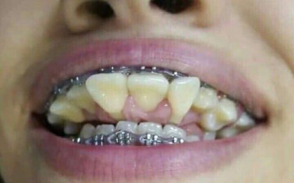 Cư dân mạng Thái Lan phát hoảng với hình ảnh hàm răng bị niềng sai cách dẫn tới biến dạng trầm trọng