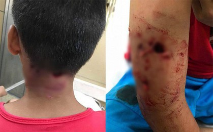 Thêm một bé trai bị chó cắn thủng tay và gáy khi cho chó ăn