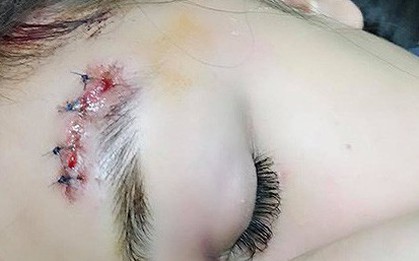 [CLIP] Lời kể của cô gái trẻ bị gã say chọc ghẹo, đánh ngất bất ngờ trong đêm