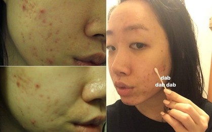Mặt đầy mụn sưng đỏ, cô nàng này đã thay đổi rõ rệt sau khi thử dùng dầu tràm trà trong 1 tuần