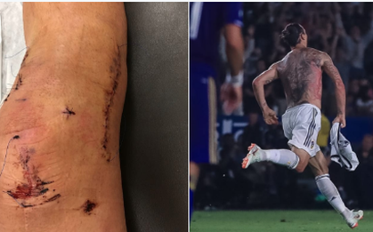 Ibrahimovic lần đầu tiết lộ hình ảnh chấn thương đáng sợ ở MU