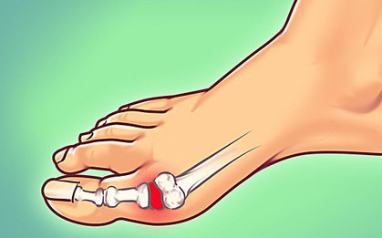 Sự thật: ngày càng nhiều người bị gout và đây là cách để hạn chế những cơn đau kinh khủng ấy