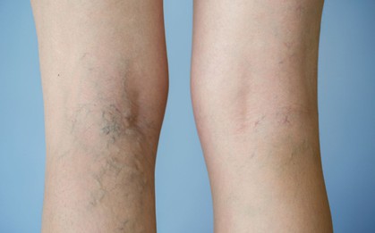 Thấy gân xanh nổi lên ở những khu vực này thì đừng chủ quan xem thường mà nên đi khám ngay