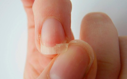 Móng tay giòn, dễ gãy có thể cảnh báo bạn đang gặp các vấn đề sức khoẻ sau