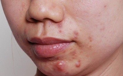 5 dấu hiệu cảnh báo bạn đang bị mất cân bằng dinh dưỡng