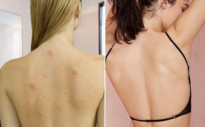Mụn nhọt trên lưng sẽ biến mất hoàn toàn nếu bạn duy trì những thói quen sau