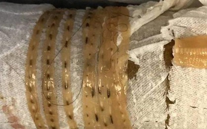 Ăn sushi triền miên tháng ngày, người đàn ông tá hỏa khi phát hiện con sán dây dài 167cm trong bụng
