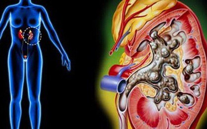 Những vấn đề về tiểu tiện này có thể là dấu hiệu của bệnh sỏi thận nhưng bạn không hề hay biết