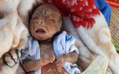 Tây Ninh: Bé trai chưa đầy 1 tháng tuổi, người đầy vảy ngứa như da trăn bị bố mẹ bỏ rơi ngoài đường