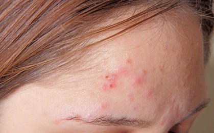 Mụn trứng cá sẽ nhanh chóng biến mất nếu bạn duy trì thường xuyên các thói quen sau