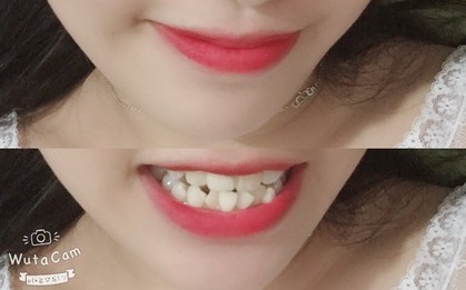 Có một nỗi đau mang tên răng 9-6-3-0: Đi đâu cũng tự ti, cười không dám cười lớn