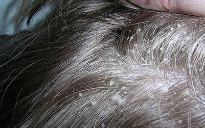 Những nguyên nhân không ngờ gây ra tình trạng nấm da đầu mà nhiều người không hề nghĩ tới