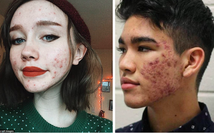 Khảo sát của chuyên gia Mỹ cho thấy mụn trứng cá có liên quan đến điểm số