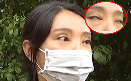 Chi 45 triệu đồng cắt mí rồi nhận lại kết quả không ra gì, cô gái trẻ chìm trong tuyệt vọng vì không thể nhắm nổi mắt