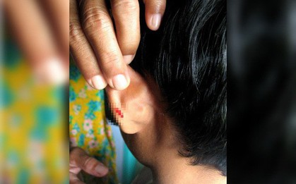 Chỉ vì không làm bài tập về nhà, nam sinh bị cô giáo đóng dập ghim vào tai đầy dã man