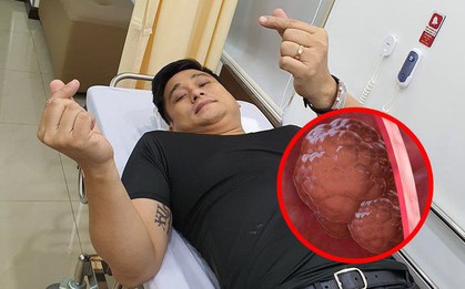 Diễn viên Minh Tiệp bị polyp đại tràng và dạ dày: tuy lành tính nhưng cũng nhiều vấn đề cần chú ý