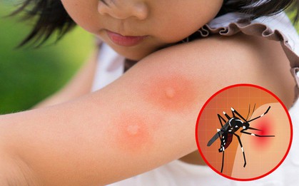 Chỉ cần 1 người trong nhà bị sốt xuất huyết, thực hiện ngay 4 biện pháp sau để không ai bị lây bệnh