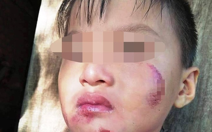 Một cháu bé 6 tuổi nghi bị chính mẹ ruột đánh dã man