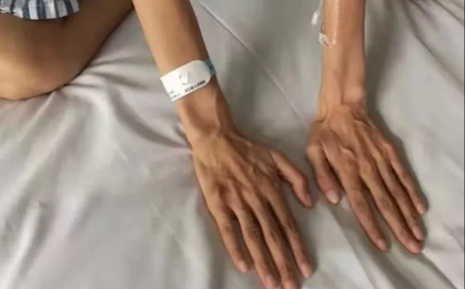Hội chứng lạ khiến người phụ nữ có chân tay gầy, dài bất thường