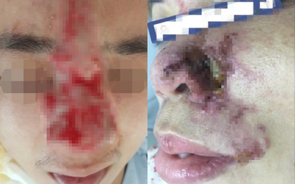Nữ bệnh nhân bị mù mắt sau tiêm filler, bác sĩ cảnh báo: Cẩn trọng những spa "chào giá" bèo nhất thị trường