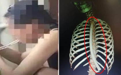 Làm theo mẹo giảm cân gây sốt MXH Trung Quốc, cô gái vô tình nuốt chửng ống nhựa dài 30cm