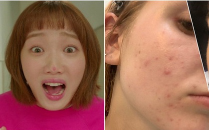 Bạn hay bị mụn ở vị trí nào? Bác sĩ sẽ chỉ ra nguyên nhân và cách chữa trị chuẩn nhất