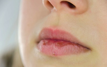 Chăm dưỡng môi nhưng đôi môi vẫn khô nứt, bong tróc thì nguyên nhân có thể là do một vài vấn đề sau
