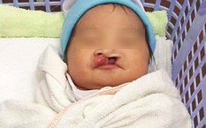 Bé gái sơ sinh hở hàm ếch bị bỏ rơi ở giữa chợ vào những ngày Tết
