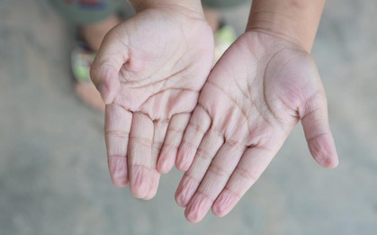 Thấy da ngón tay nhăn nheo có thể là do một trong các vấn đề sức khỏe sau