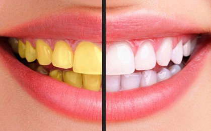 Mỗi ngày chỉ đánh răng 1 lần, bạn có nguy cơ cao mắc phải những vấn đề sau