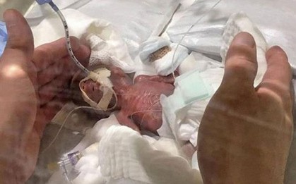 Nhật Bản: Cứu sống bé trai nhỏ nhất thế giới