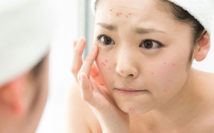 Khiên chắn bảo vệ da trong mùa hè nắng nóng