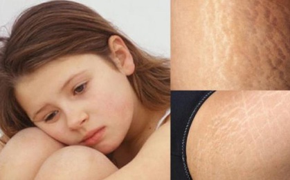 Đừng để rạn da trở thành rào cản “đánh cắp” sự tự tin của bạn
