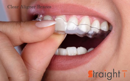 Straigh-T: Công nghệ niềng răng trong suốt cho nụ cười luôn xinh tươi