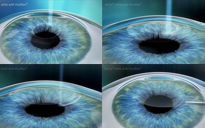 So sánh 3 phương pháp phẫu thuật khúc xạ phổ biến hiện nay: Lasik – Femto Lasik và Relex Smile