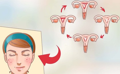 Loại mụn mà tuổi dậy thì rất hay gặp phải nếu không chữa trị đúng cách có thể đeo bám đến khi trưởng thành