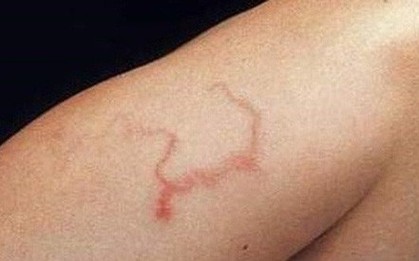 Ớn lạnh những ca nhiễm ký sinh trùng "có một không hai”