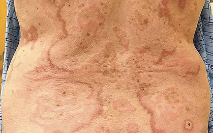 Da nổi nhiều vết ban loang lổ, đi khám mới biết mình mắc bệnh ung thư ở nơi chẳng ai ngờ tới
