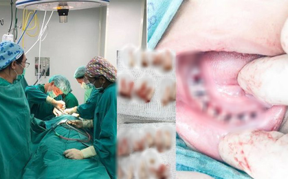 Nha sĩ đăng ảnh nhổ 18 răng sâu của cháu bé không chịu đánh răng kèm theo chia sẻ được nhiều bố mẹ đồng cảm