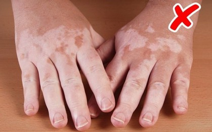 Cẩn thận với những bệnh nguy hiểm được thông báo qua dấu hiệu bất thường trên làn da