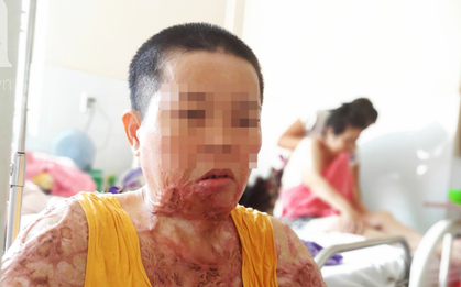 Người phụ nữ bị tình cũ tạt axit bỏng nặng sau khi níu kéo tình cảm không thành